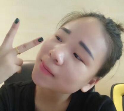 在寧波尚美醫(yī)院做的鼻子綜合整形效果不錯