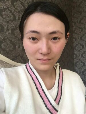 太原美之妍全臉脂肪填充+自體脂肪豐胸恢復(fù)效果圖