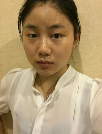 廣州妍雅割雙眼皮后恢復過程圖