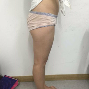 青?？等A馮相周醫(yī)生大腿抽脂案例分享