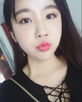 武漢美亞金國華醫(yī)生幫我做的自體脂肪全臉填充效果恢復案例