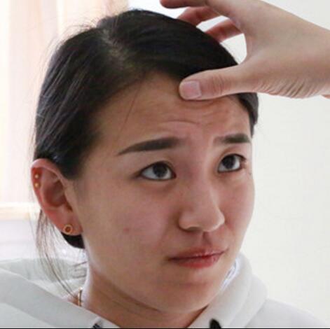肉毒素去抬頭紋眉間紋恢復(fù)過程圖，真實案例分享