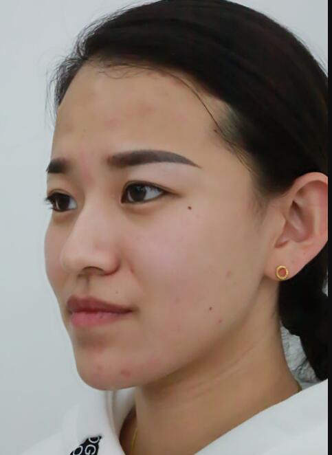 肉毒素去抬頭紋眉間紋恢復(fù)過程圖，真實案例分享
