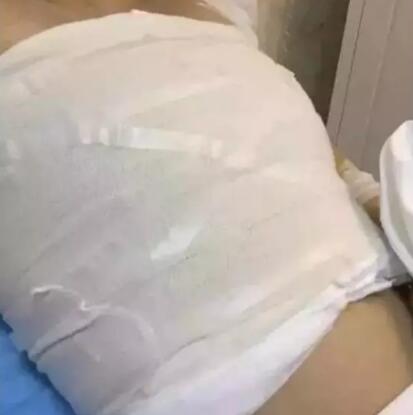 唐山美仁整形美容醫(yī)院做的假體隆胸手術(shù)恢復過程分享