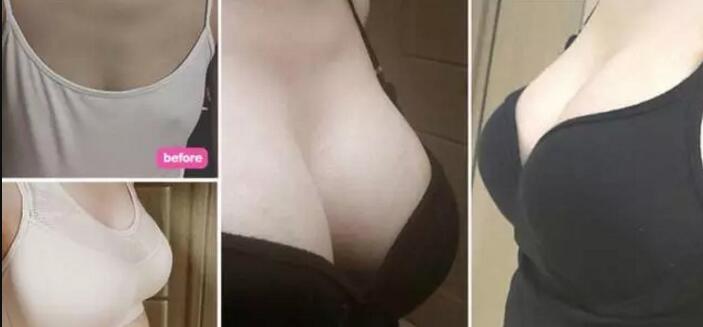 唐山美仁整形美容醫(yī)院做的假體隆胸手術(shù)恢復過程分享