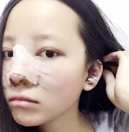 武漢愛美匯鼻綜合整形恢復(fù)期圖片