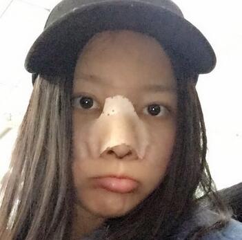 武漢愛美匯鼻綜合整形恢復(fù)期圖片