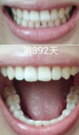 牙齒矯正前后對比圖，成人牙齒矯正費用9800元——成都格林口腔醫(yī)院