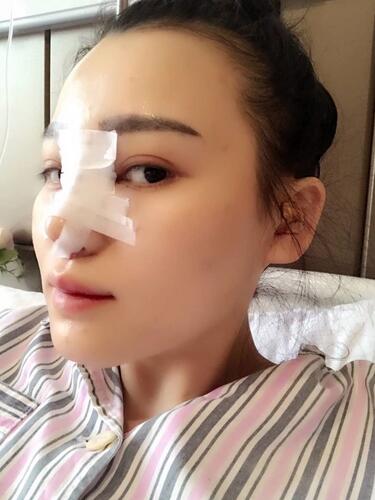 上海九院李圣利鼻綜合真實(shí)恢復(fù)期圖片
