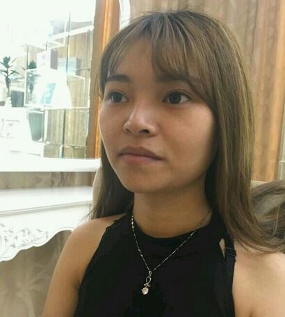 鼻綜合真實恢復期圖片 杭州東方鼻綜合四個月