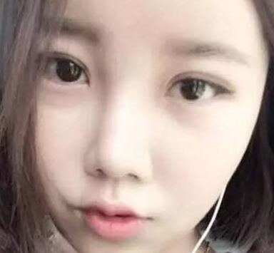 雙眼皮整形前后對比圖，單眼皮變雙眼皮整容日記