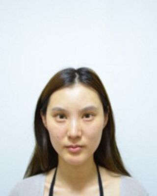 全面部自體脂肪填充恢復照片，北京京美真實案例