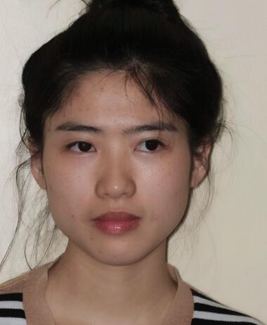 北京八大處下頜角截骨前后效果對比