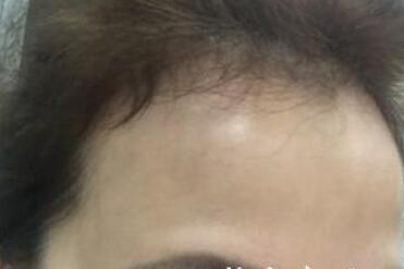 去抬頭紋最好的方法？肉毒素去抬頭紋魚尾紋