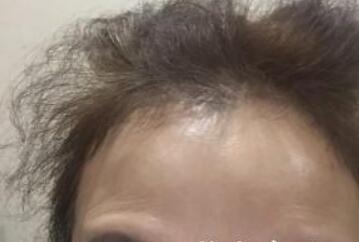 去抬頭紋最好的方法？肉毒素去抬頭紋魚尾紋