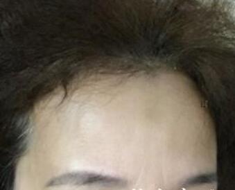 去抬頭紋最好的方法？肉毒素去抬頭紋魚尾紋