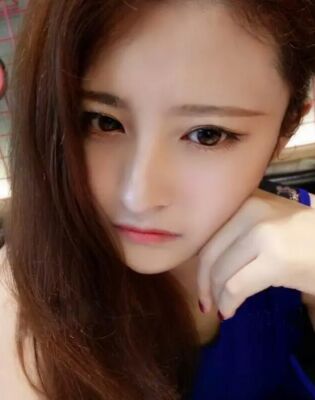 深圳易容顏全切雙眼皮后恢復過程圖