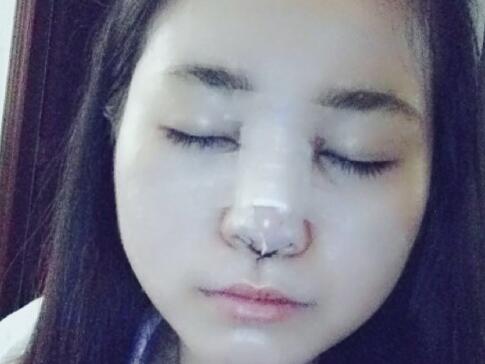 鼻綜合整形價格和真實恢復(fù)期圖片