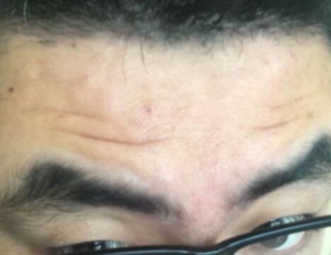 男生注射肉毒素去除抬頭紋魚尾紋案例分享