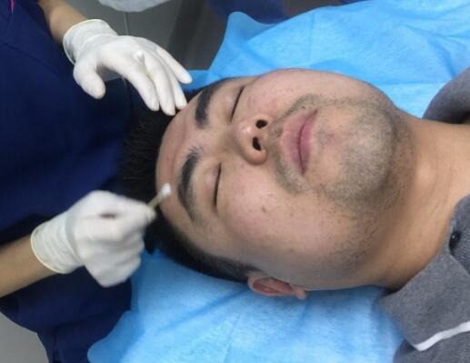 男生注射肉毒素去除抬頭紋魚尾紋案例分享