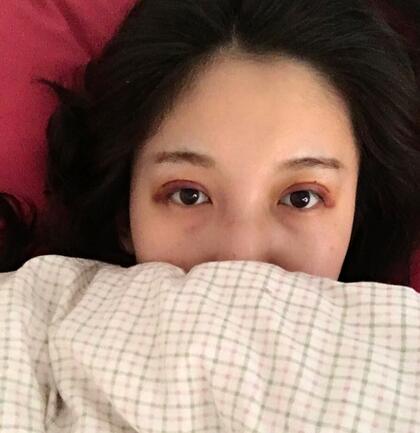 天津繆慈割雙眼皮恢復(fù)圖