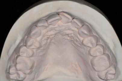 成都圣貝口腔醫(yī)院做了全冠修復(fù)，牙齒排齊美白前后對比效果圖