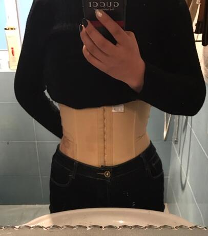 腹部吸脂兩個月親身經歷 深圳仁安雅吸脂案例