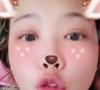 切開雙眼皮+開眼角手術(shù)前后對(duì)比圖恢復(fù)過程 昆山時(shí)光整形醫(yī)院