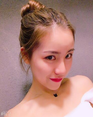 北京藝星王英勇隆鼻案例 鼻綜合三個月